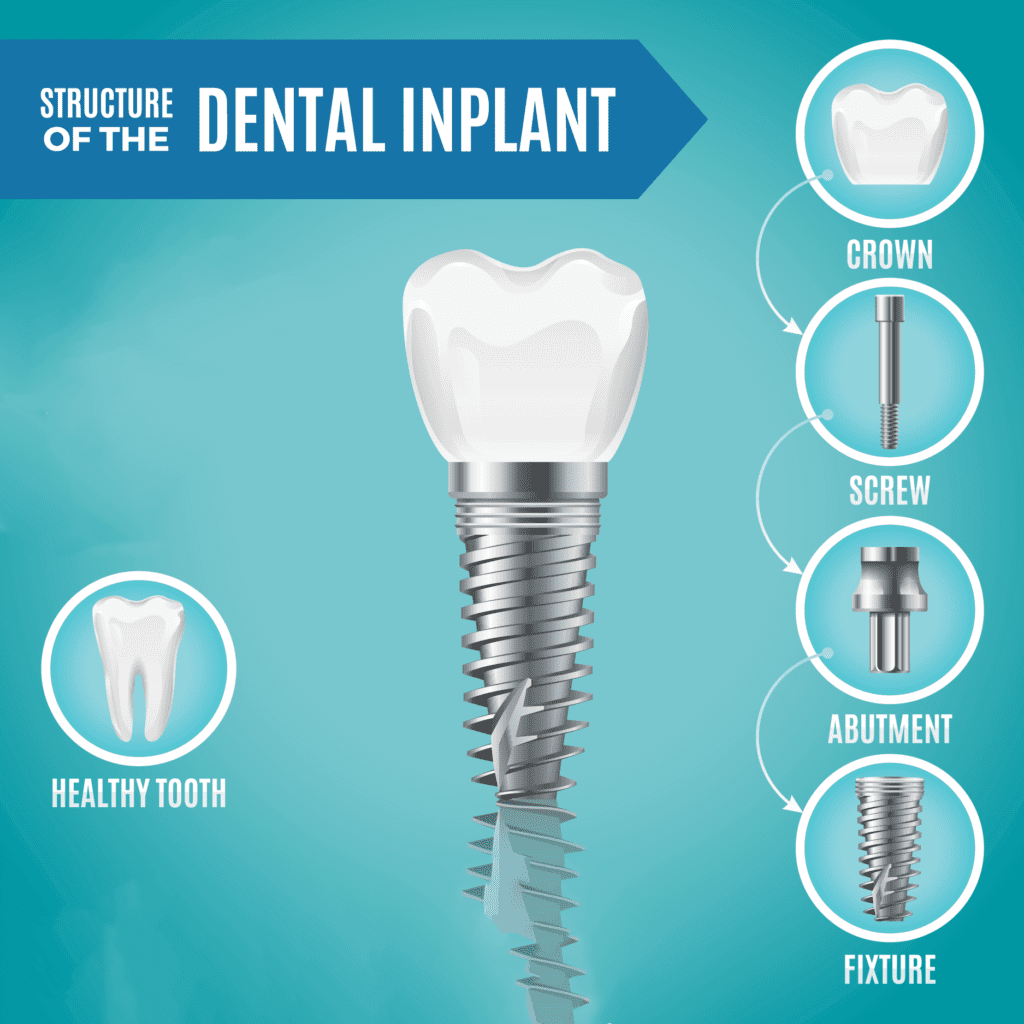 Dentists often recommend dental implants for their numerous benefits. Understanding why can help you make an informed decision.